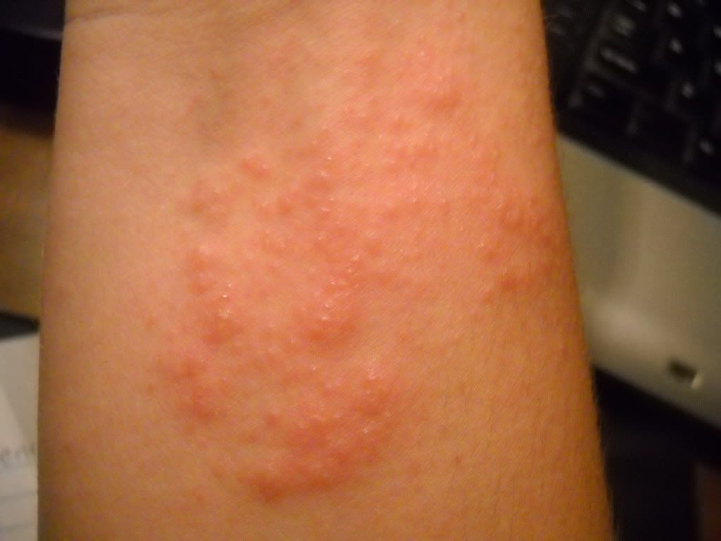 Red Itchy Rash On Wrist - Doctor answers on HealthTap
